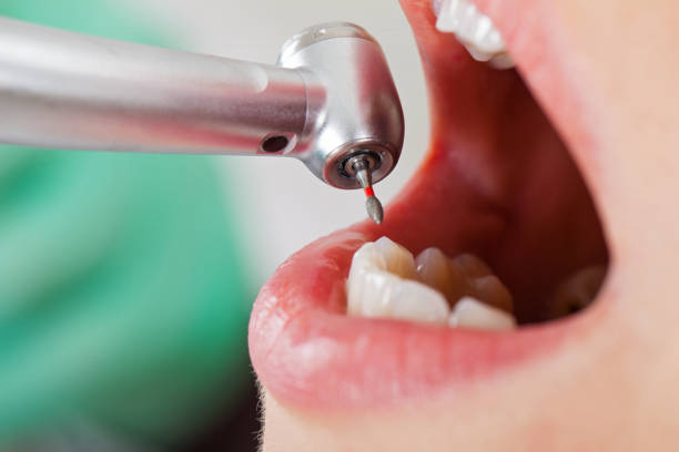 Best Emergency Tooth Extraction in Woodbine, IA